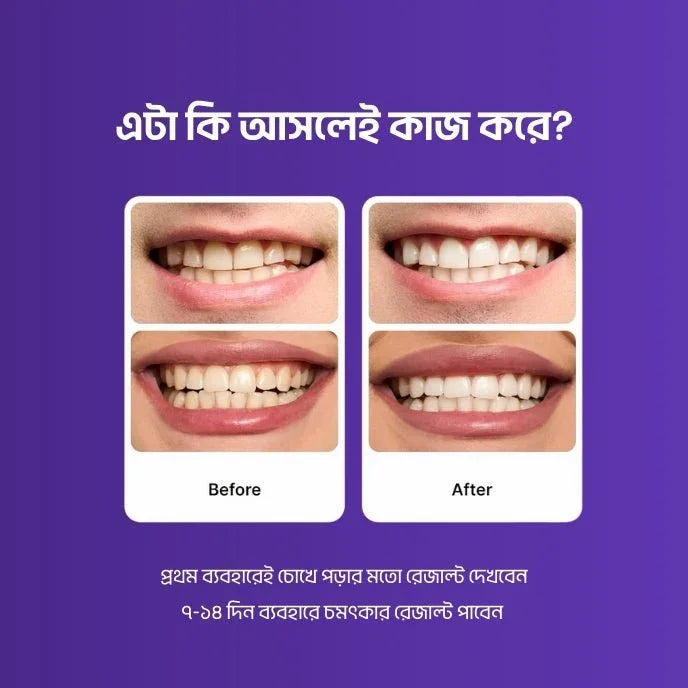 Teeth Whitening Strips - Shokhi Beauty